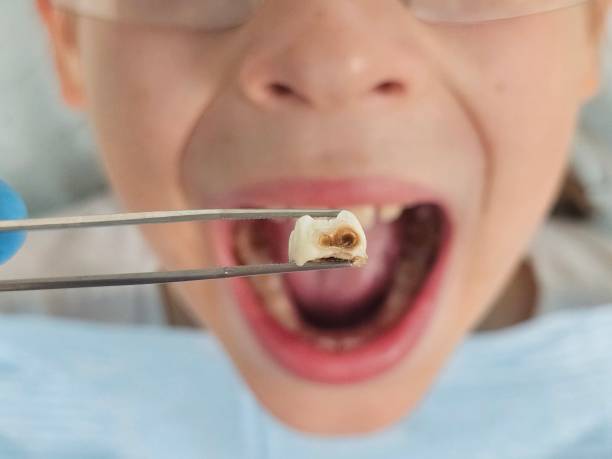 Best Emergency Tooth Extraction in Vley Grande, AL